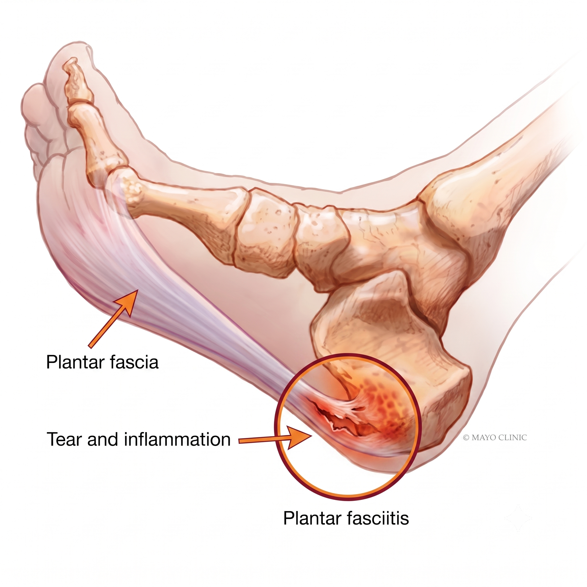Showing Plantar Fasciitis